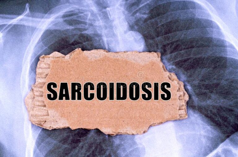 Read more about the article Σαρκοείδωση – Ανδρέας